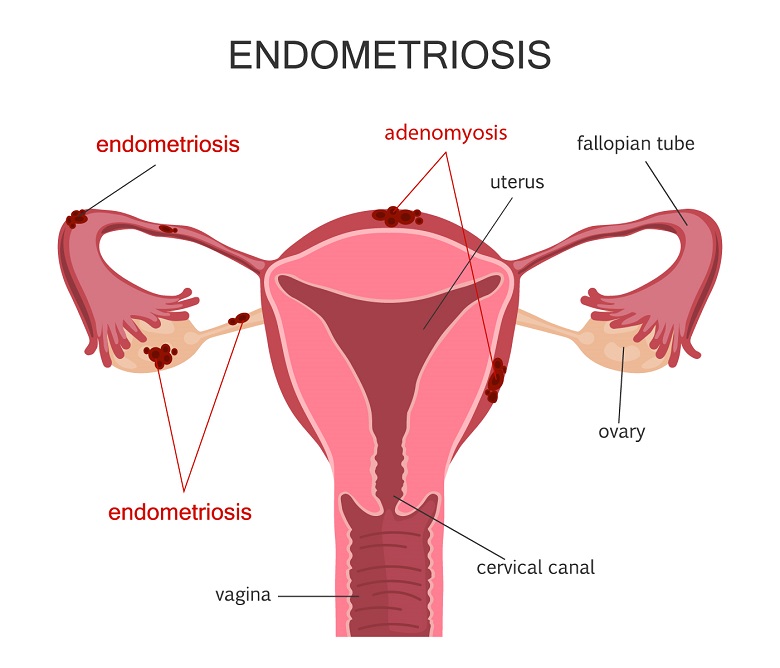 Endometriosis: Causes, Symptoms, and its Impact on Fertility