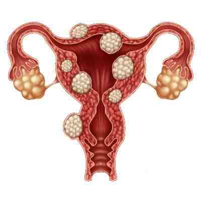 Fibroids and Fertility: Understanding the Roadblocks and Treatment Options